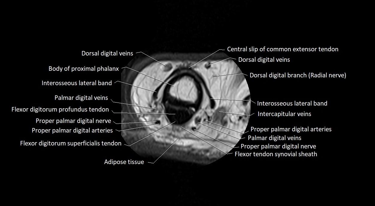 Finger anatomy axial cross sectional 3T image image 19.webp